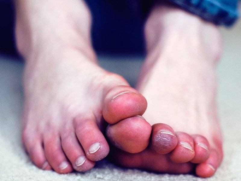 Рожеве запалення ніг — як вийти із ситуації?